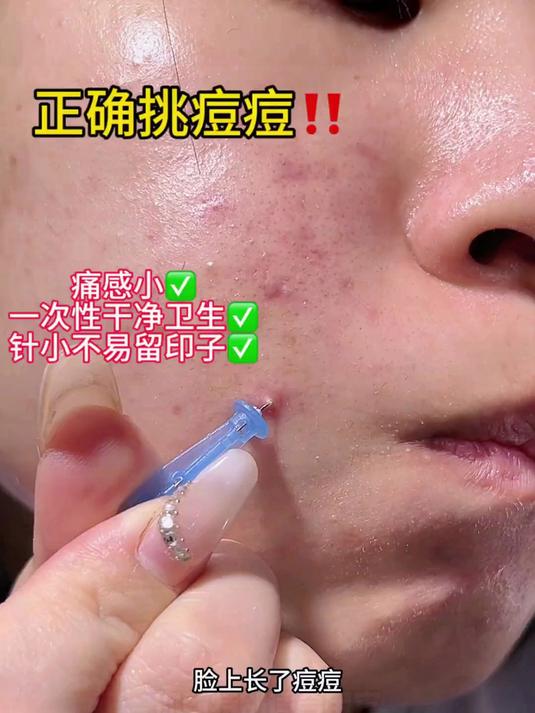 清痘神器来啦!这款粉刺针暗疮针真的是好用,避免交叉感染