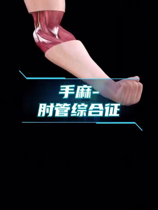 肘管综合征：手麻背后的尺神经卡压问题全解析