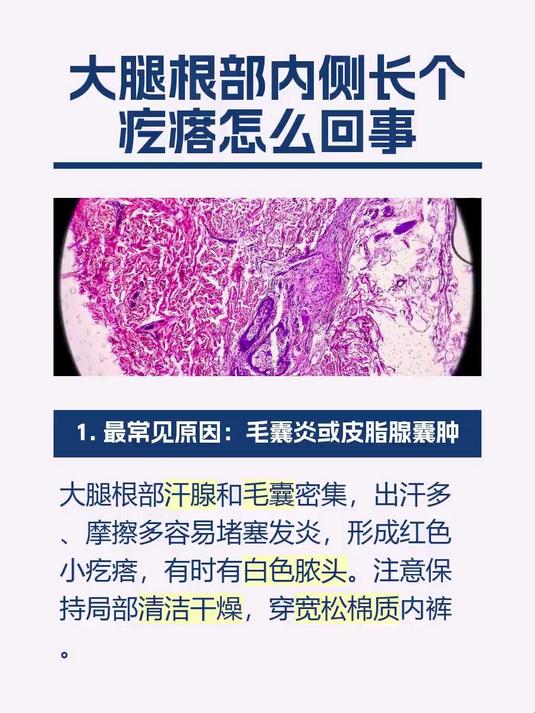 #马上健康过大年#大腿根部内侧长个疙瘩怎么回事