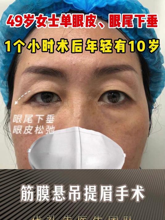 49岁女士单眼皮、眼尾下垂,勇敢做提眉手术