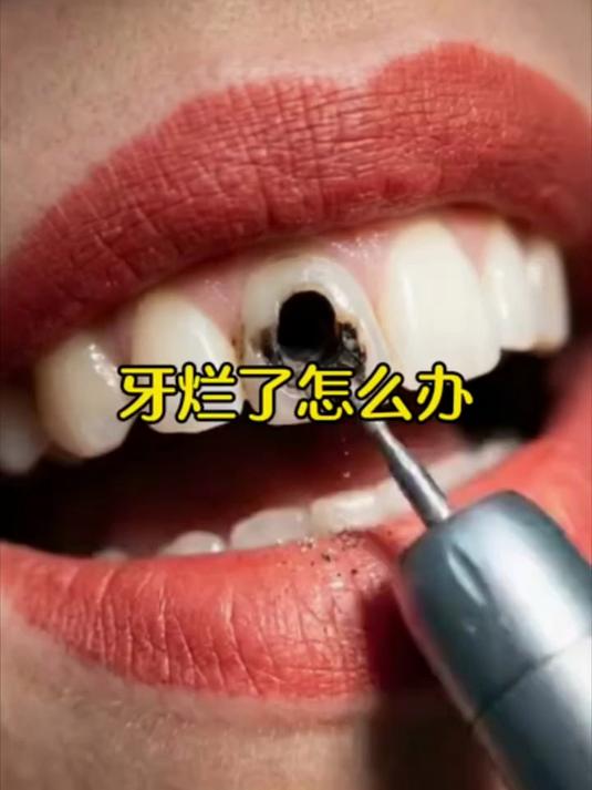 牙齿烂了该怎么办!
