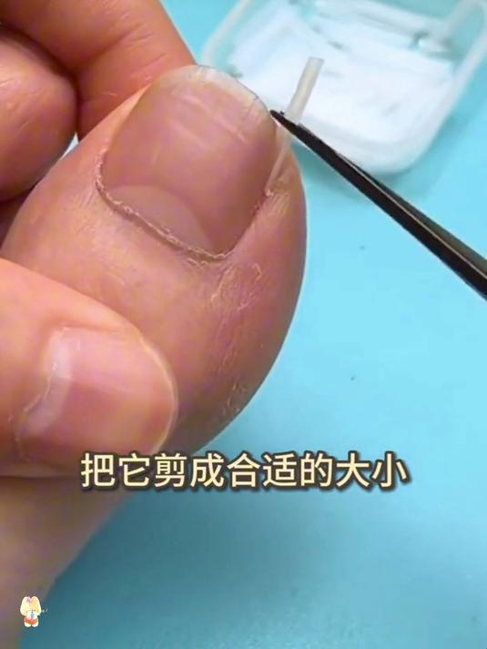 甲沟困扰者!分离片垫指甲,不卡肉超舒服自在