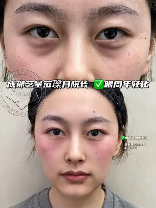 医美大白说真话丨30+女生眼周抗衰思路