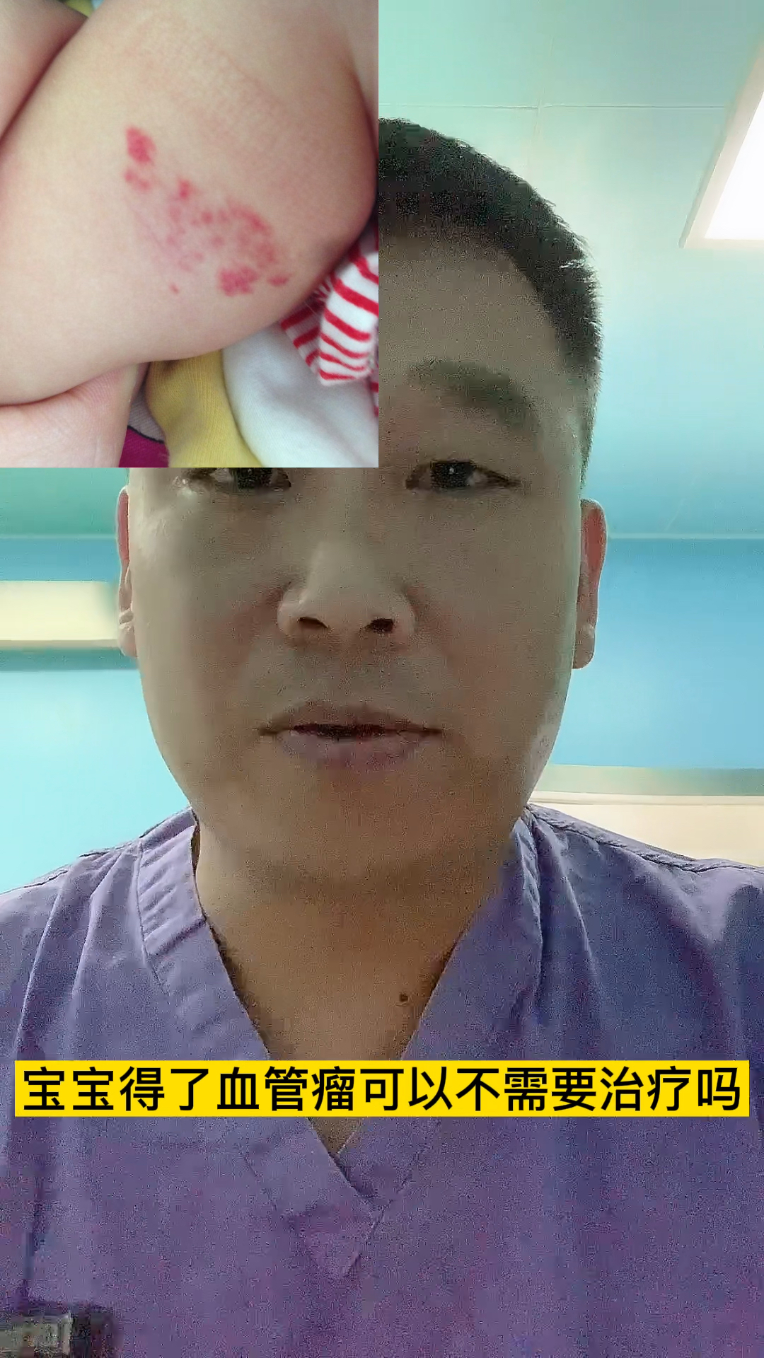 儿童血管瘤可以不治疗,但需要满足四个条件