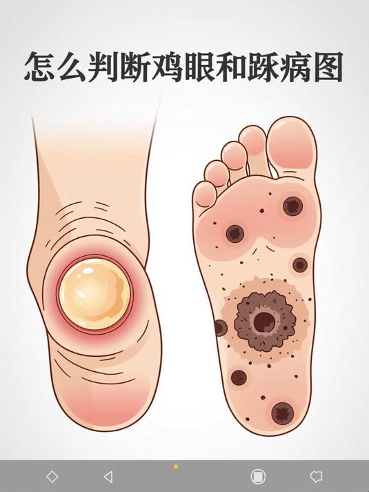 怎么判断鸡眼和跖疣图