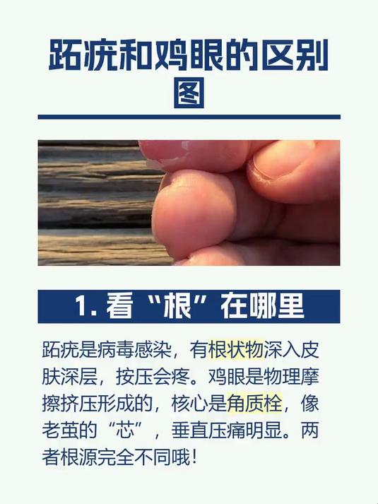 跖疣和鸡眼的区别图