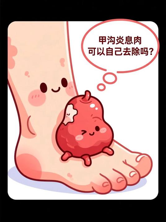 甲沟炎息肉可以自己去除吗