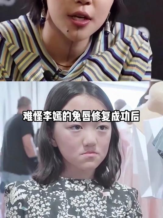 324.明明早年无任何异常,为何窦靖童虾线和李嫣的兔唇一同消失?真相曝光才懂深入血脉的姐妹