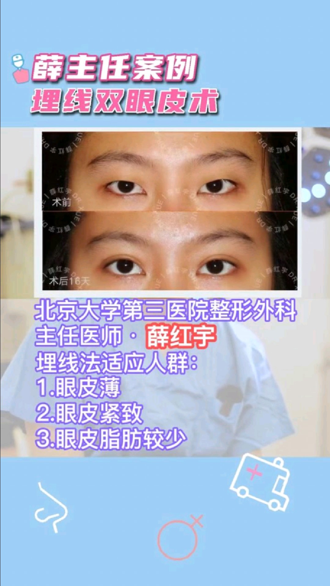 不开刀也能拥有灵动大眼睛!埋线双眼皮术后16天,恢复快无痕迹