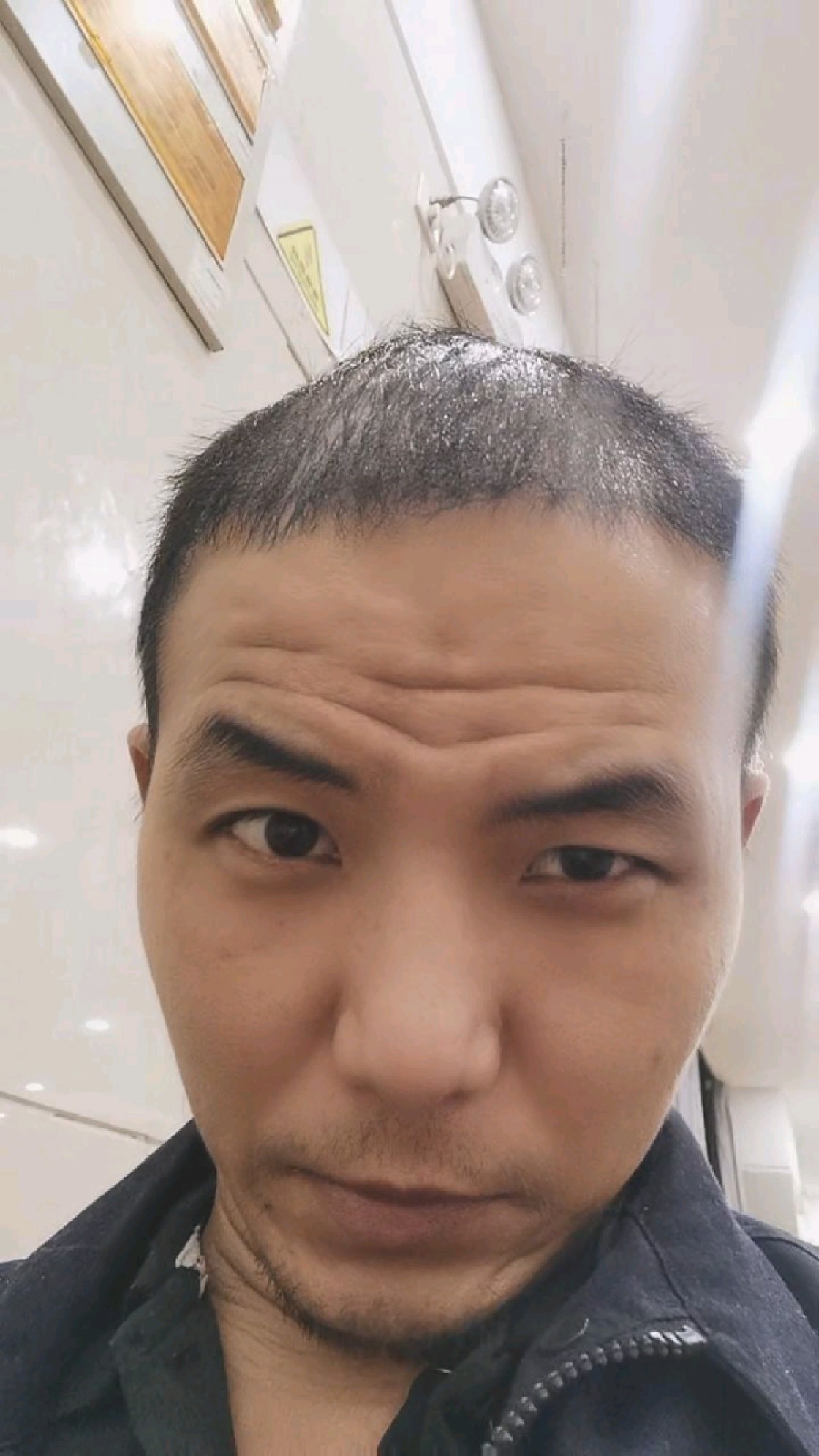 植发第163天:土豆丝胡萝卜红烧肉,吃不动大肉了