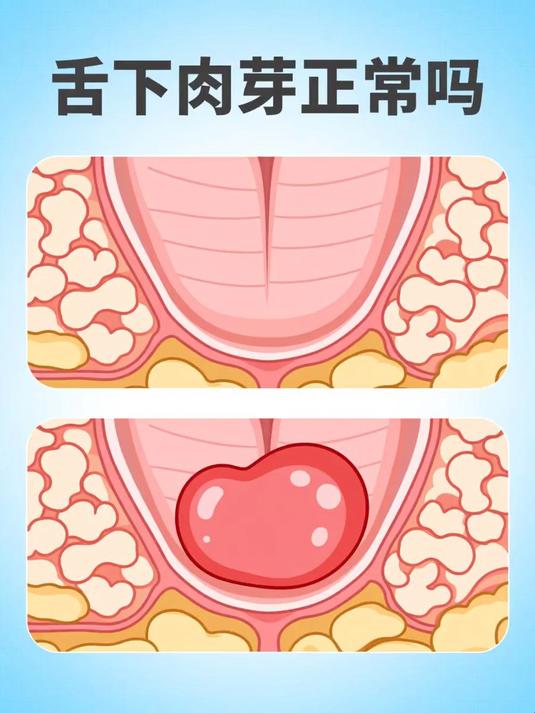 舌下肉芽正常吗