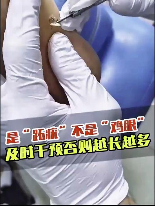 是跖疣不是鸡眼，及时干预否则越长越多！