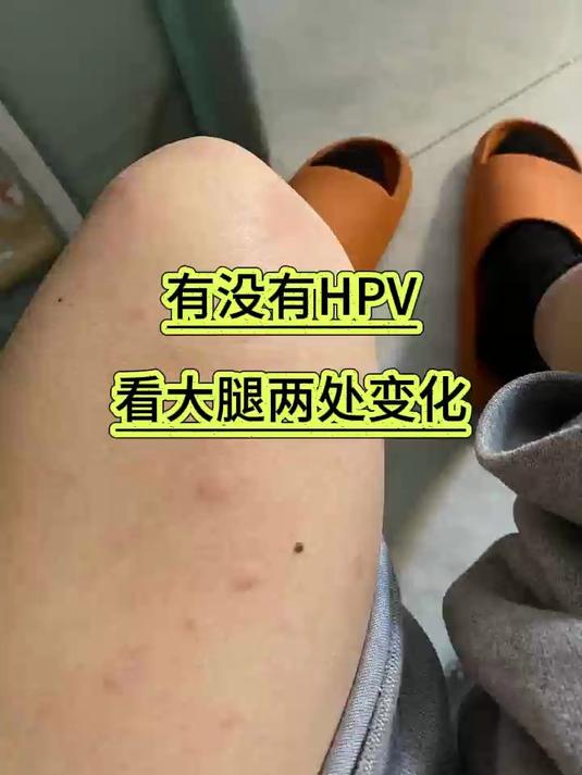 有没有HPV，看大腿两处变化