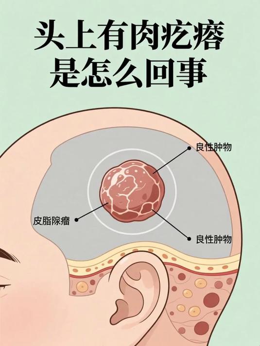 头上有肉疙瘩是怎么回事 #健康扬帆季#