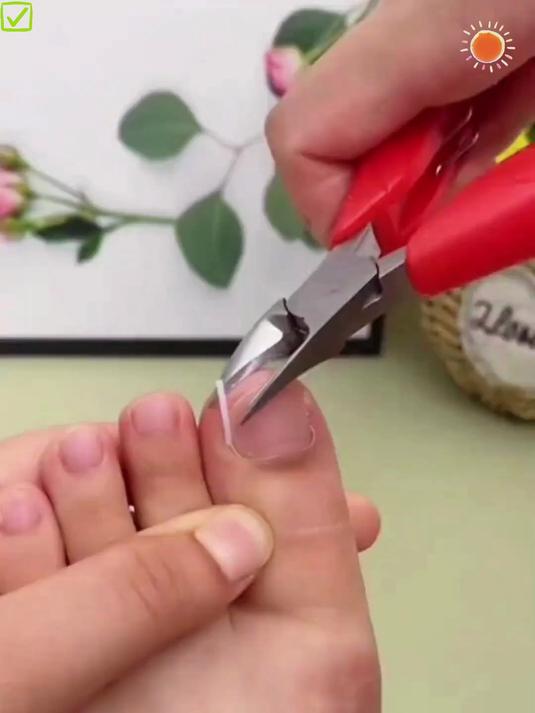 嵌甲分离片,指甲不去往肉长,像隔软垫般特别舒适!