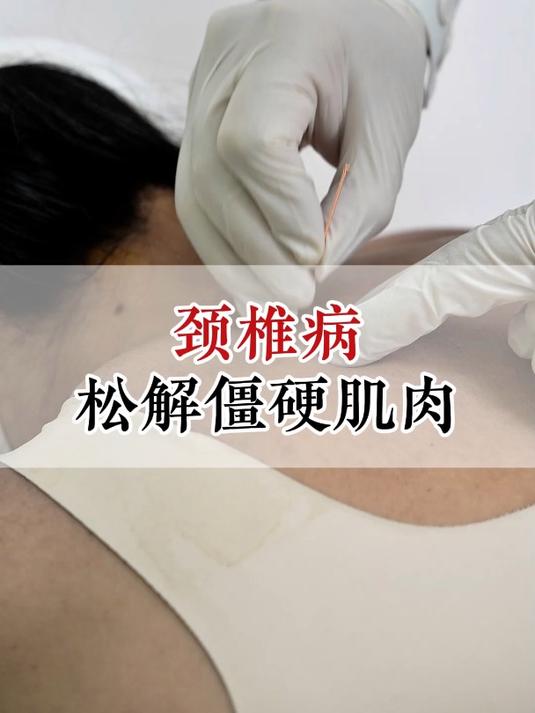 颈椎病,松解僵硬肌肉