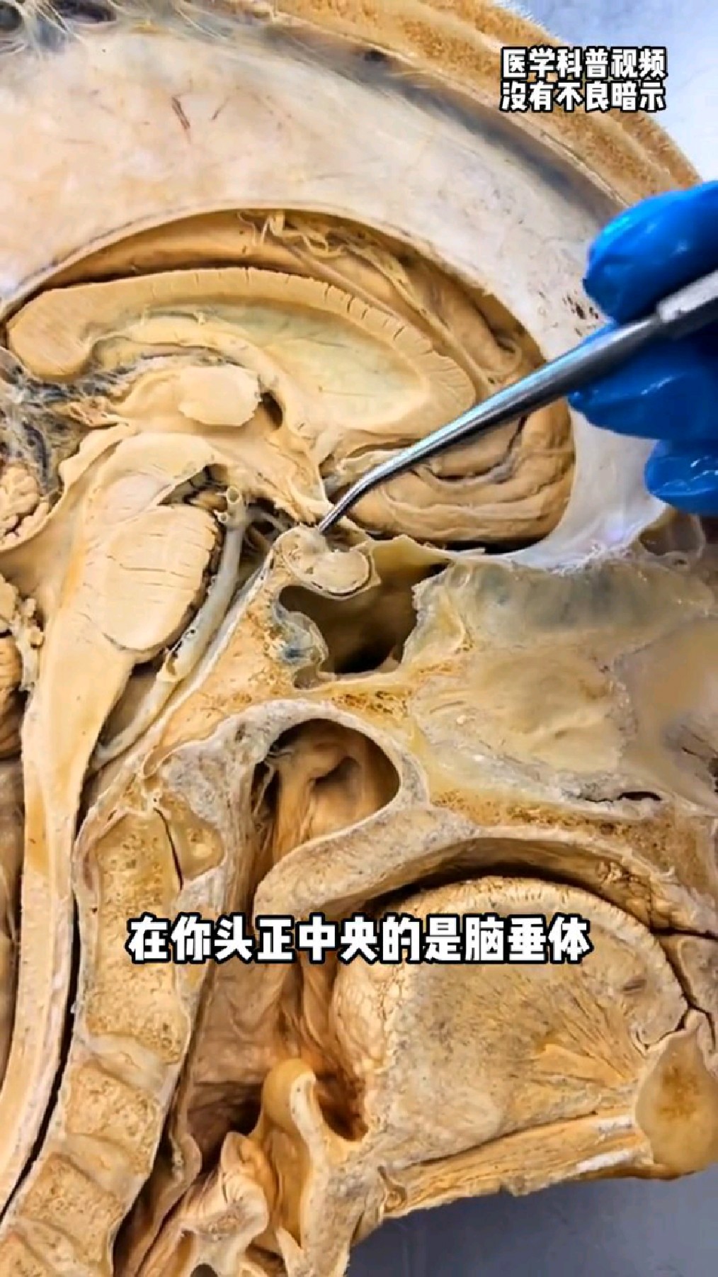 脑垂体大体解剖