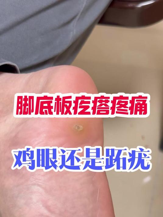 脚底板疙瘩疼痛鸡眼还是跖疣?