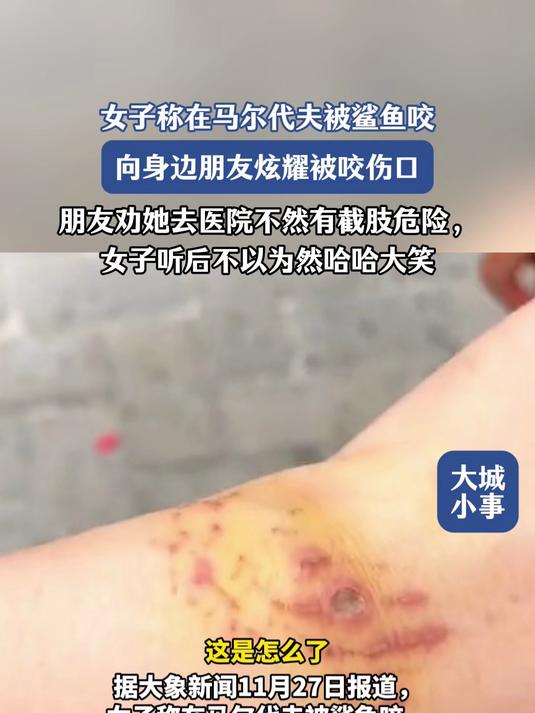 女子称在马尔代夫被鲨鱼咬,向身边朋友炫耀被咬伤口