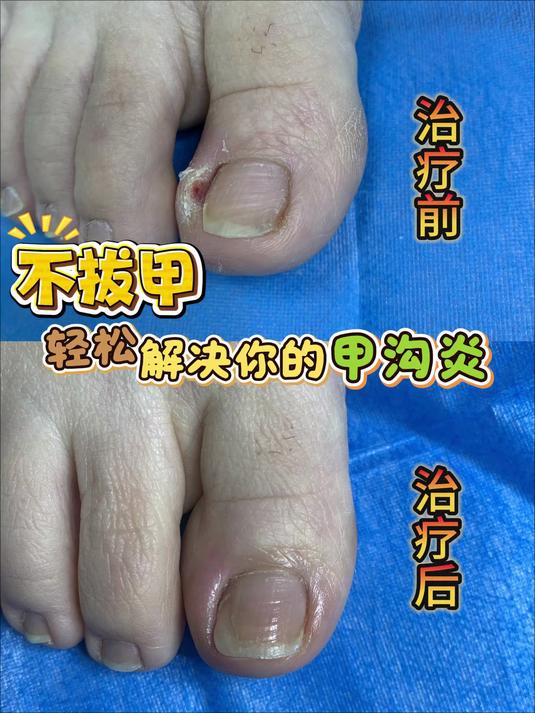 部分甲沟炎是可以做趾甲修补的