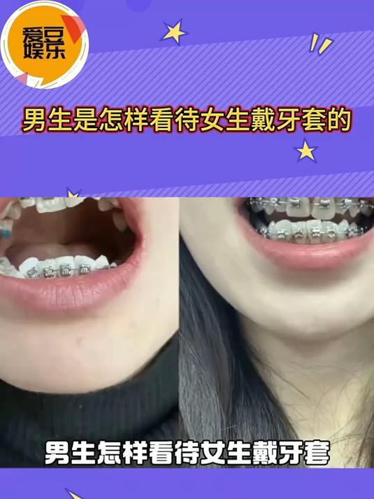 男生是怎样看待女生戴牙套的