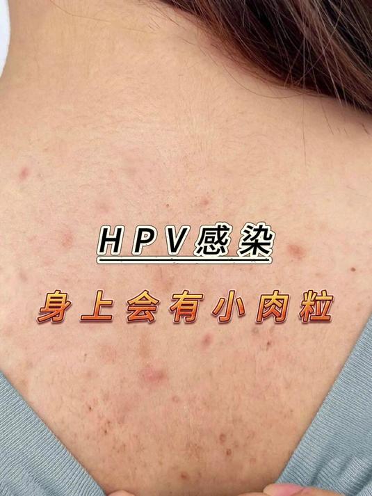 HPV感染，身上会有小肉粒