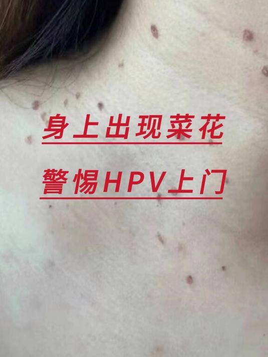 身上出现菜花，警惕HPV上门