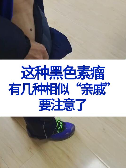 黑色素瘤,痦子,黑色素痣