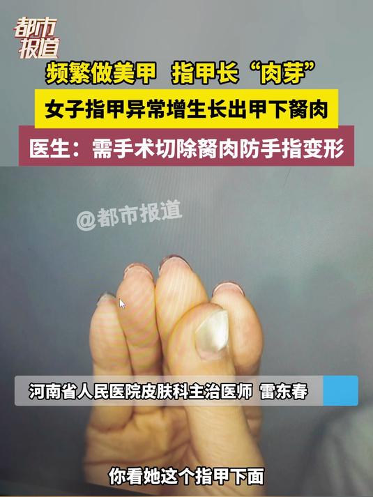 频繁做美甲 指甲长“肉芽”女子指甲异常增生长出甲下胬肉 医生：需手术切除胬肉防手指变形