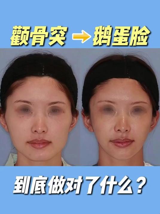 颧骨突→鹅蛋脸之间到底做了什么?把脸改成这样你觉得合适吗?