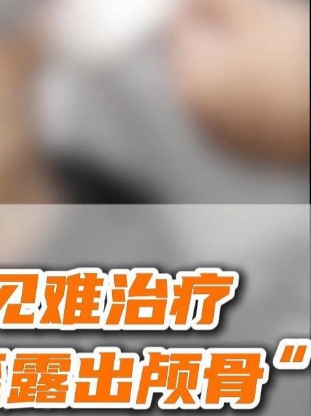 血管肉瘤罕见难治疗 患处破溃甚至露出颅骨