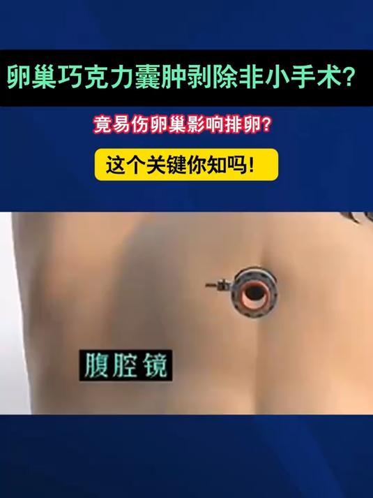 卵巢巧克力囊肿剥除非小手术？竟易伤卵巢影响排卵？