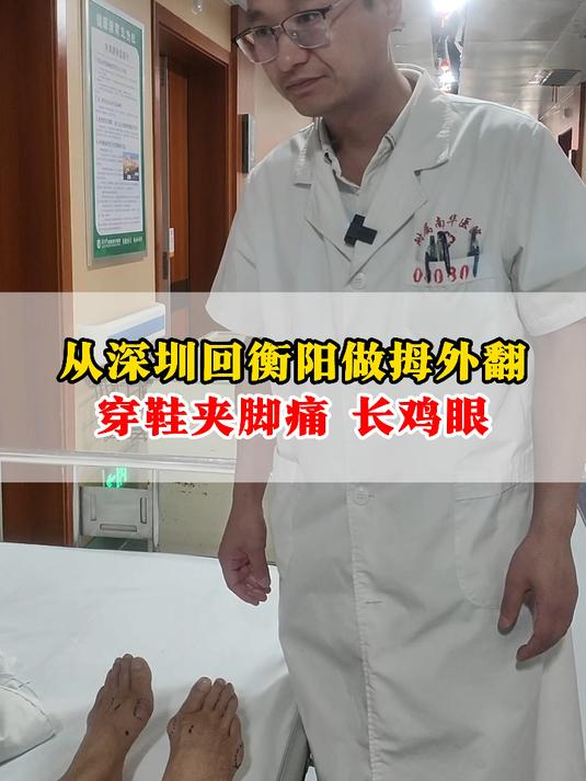 从深圳回衡阳做拇外翻,穿鞋夹脚痛 长鸡眼
