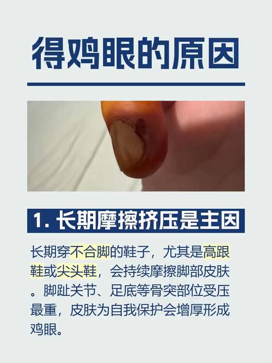 #马上健康过大年#得鸡眼的原因