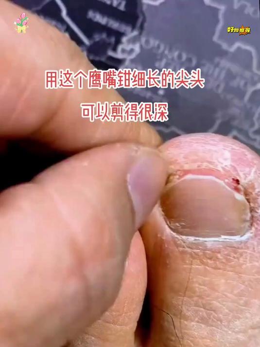 指甲往肉里长疼的走不了，试试尖嘴设计的鹰嘴钳深入甲沟剪掉嵌甲