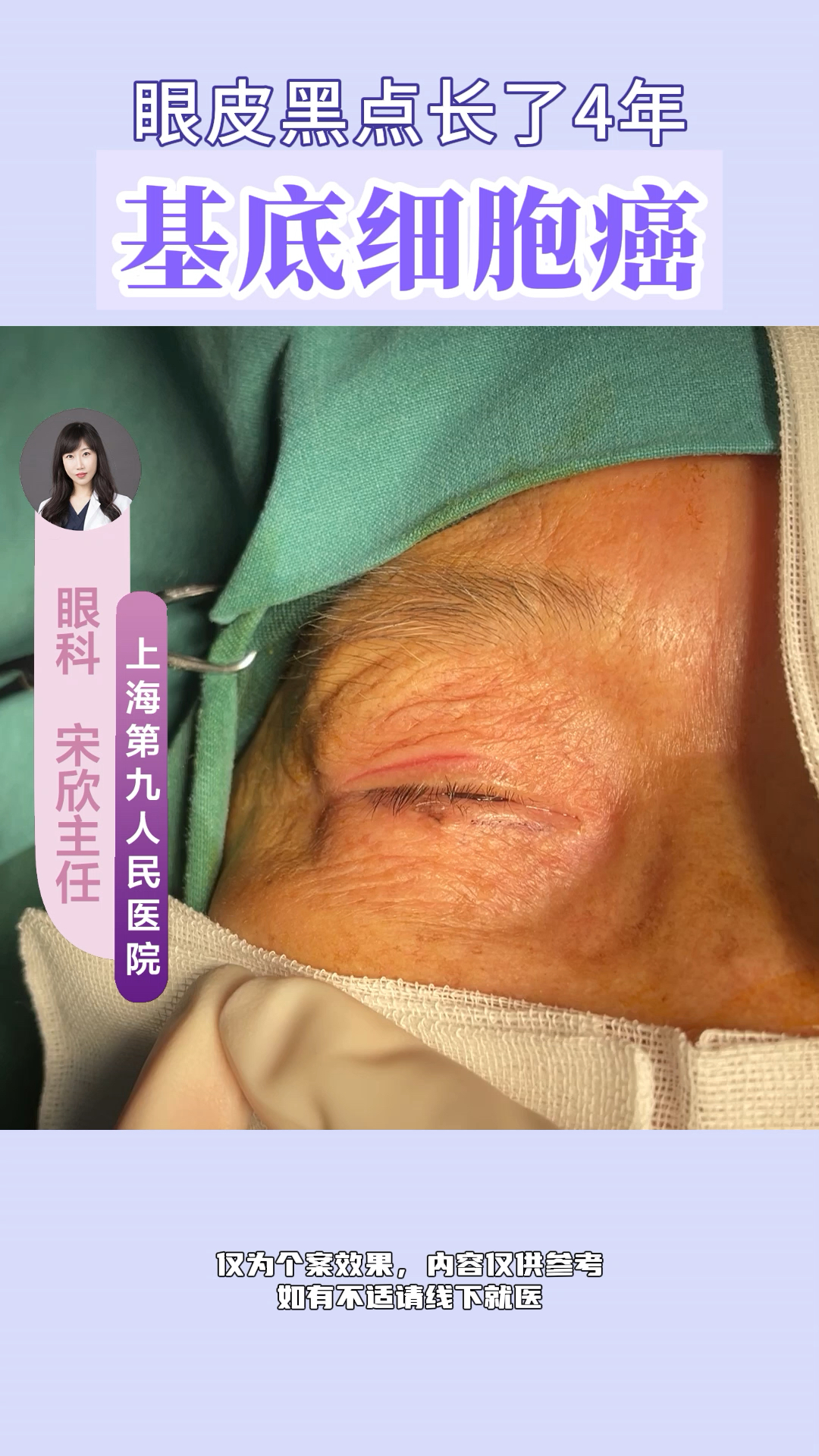 长了4年的眼皮黑点,原来是癌