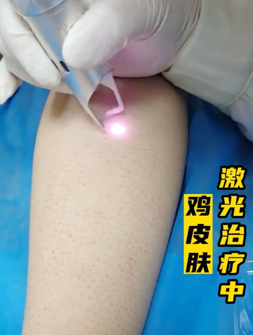 治疗动态,激光鸡皮肤治疗