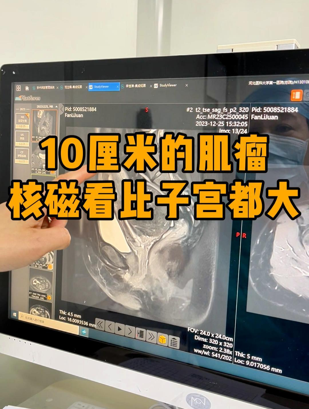 10厘米的肌瘤核磁下看比子宫都大