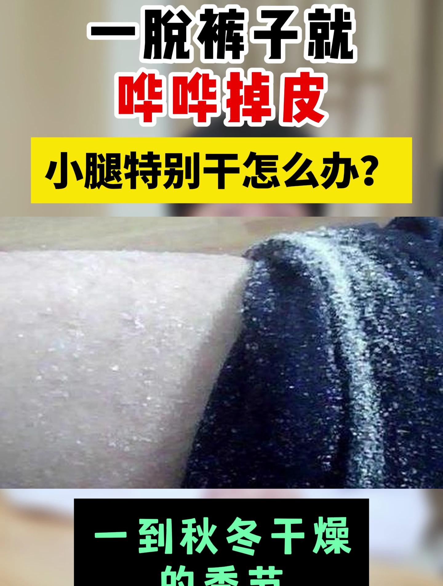 一脱裤子就哗哗掉皮 小腿特别干怎么办?