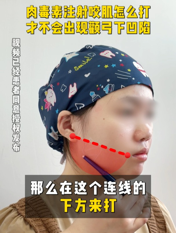 肉毒素注射咬肌怎么打才不会出现颧弓下凹陷?