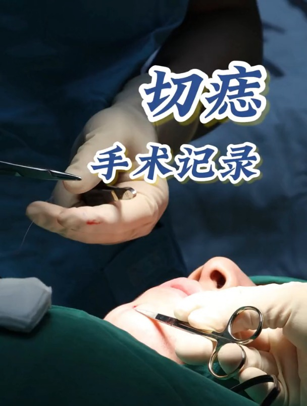 切痣手术记录