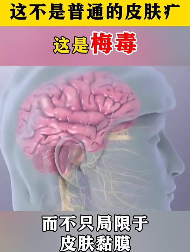 这不是普通的皮肤病,这是梅毒