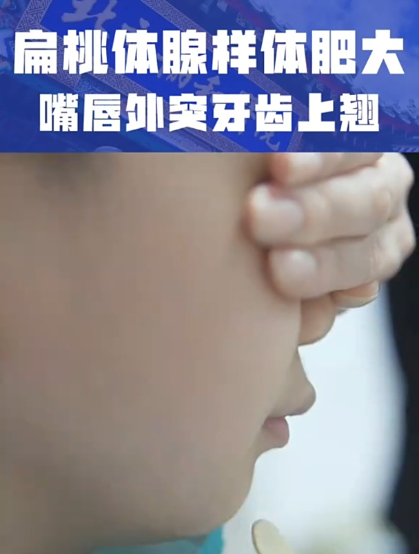 扁桃体 腺样体肥大 嘴唇外凸牙齿上翘