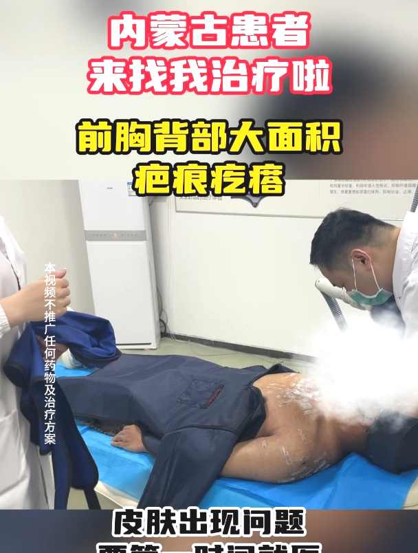内蒙古患者前胸背部长出大面积“肉疙瘩” srt100浅层照射中……