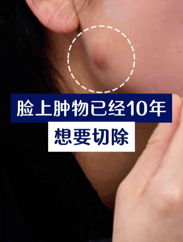脸上肿物,已经有10年,现在往外流水,想要切除