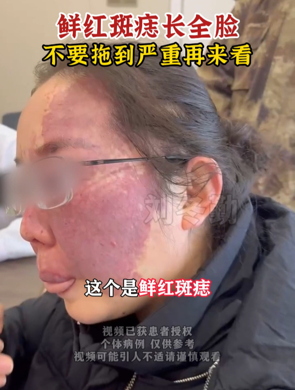 鲜红斑痣长全脸,不要拖到严重再来看