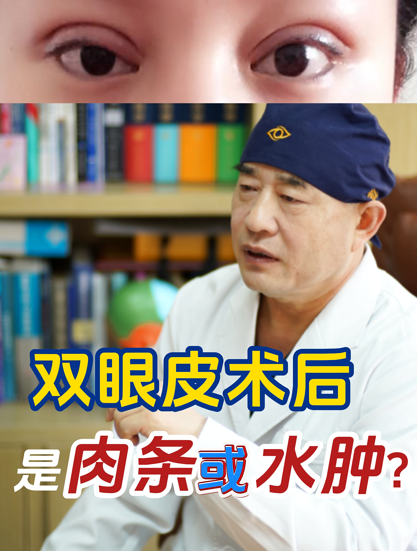 双眼皮手术后,是水肿还是产生肉条了?你一定想知道!