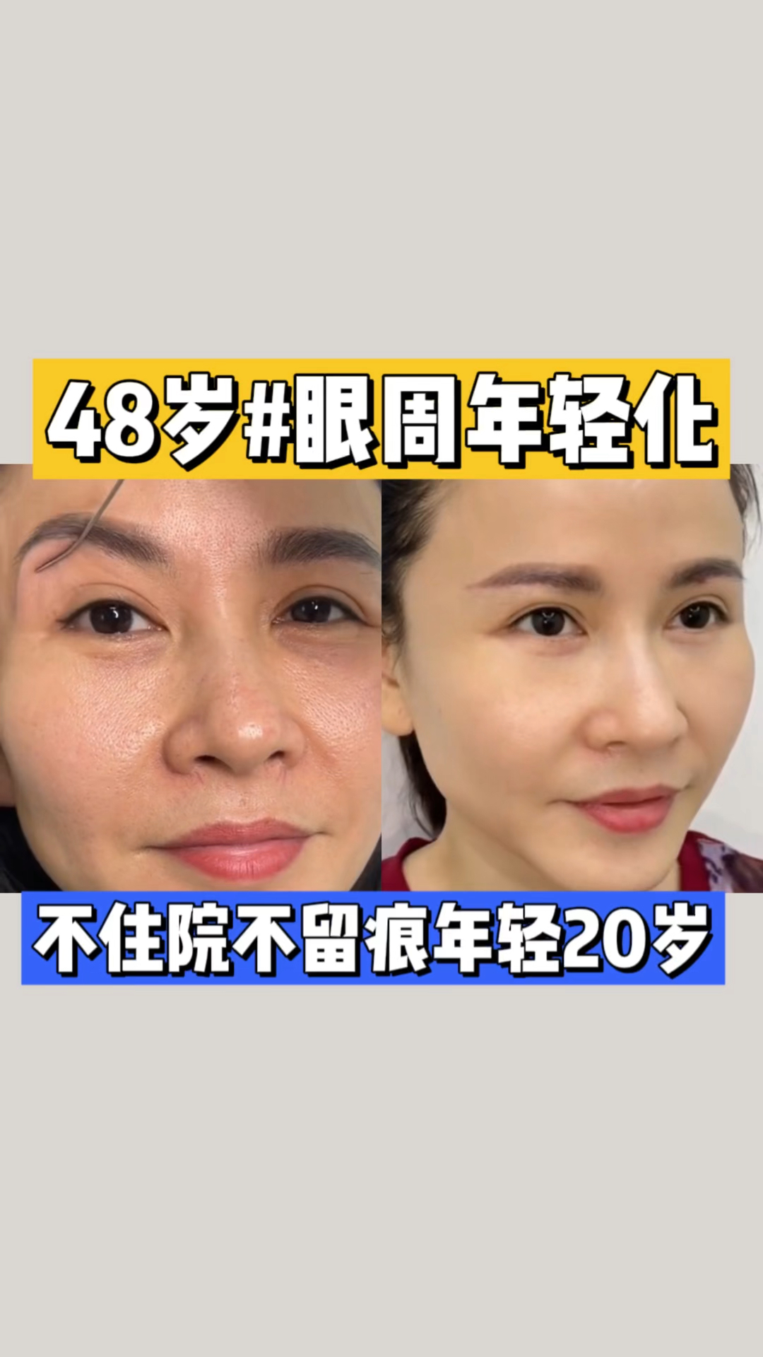 48岁眼皮松弛下垂、泪沟细纹明显,做完眼周年轻化即刻明亮双眼,随做随走年轻20岁!