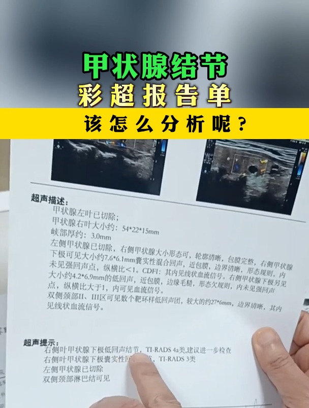 甲状腺结节4a 类,你会看甲状腺彩超报告吗?