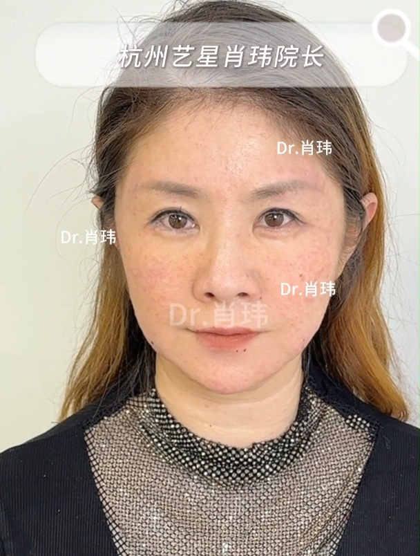 皮肉分离感+松垂+口角囊袋怎么改善?